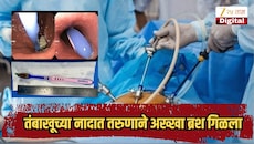 तंबाखूच्या नादात तरुणाने अख्खा ब्रश गिळला, तब्बल 12 तास टूथब्रश पोटातच राहिला, अखेर...