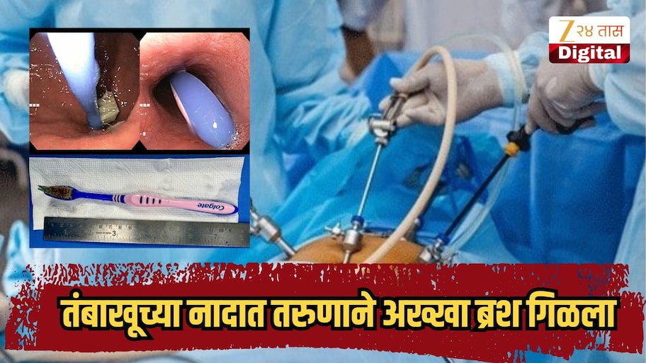 तंबाखूच्या नादात तरुणाने अख्खा ब्रश गिळला, तब्बल 12 तास टूथब्रश पोटातच राहिला, अखेर...